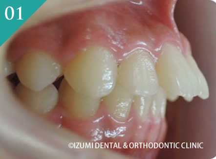 出っ歯(上顎前突、下顎の後位症)のインビザライン症例