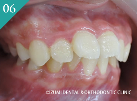 出っ歯(上顎前突、下顎の後退症)