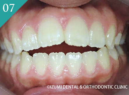 前歯が開いている(開咬)