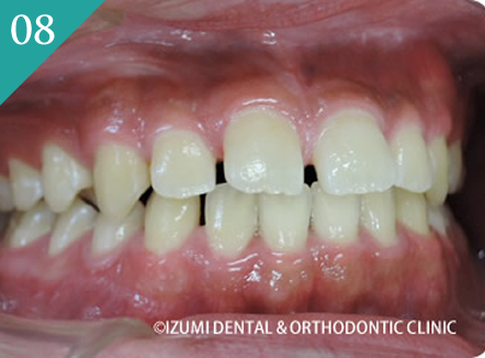 隙間が気になる(空隙歯列)