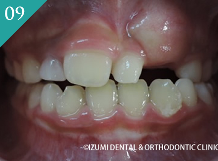 上下顎の低成長と低咬合インビザラインファースト症例