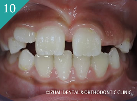 10歳未満の矯正(インビザライン・ファースト)
