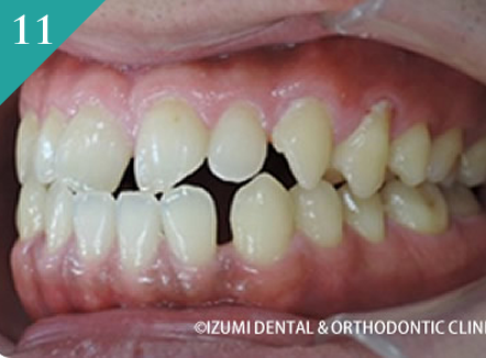 下顎が出ている(反対咬合、受け口)